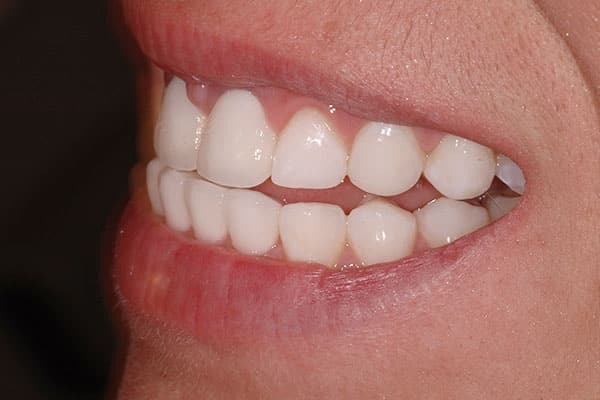 Mississauga porcelain veneers transformation close-up