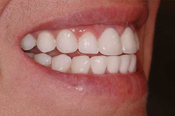 Gorgeous dental transformation with laser teeth whitening