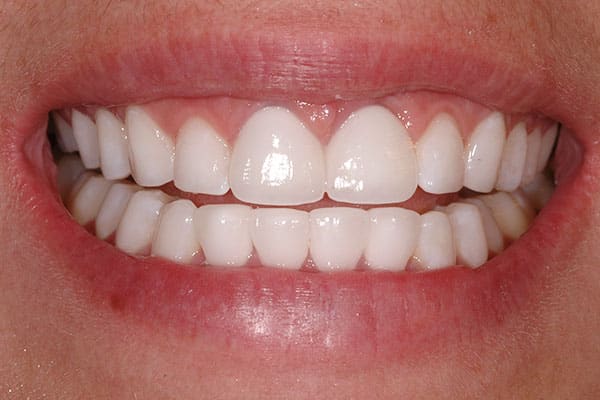 Cosmetic dental treatment results