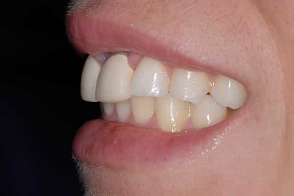 Cosmetic dental procedure results