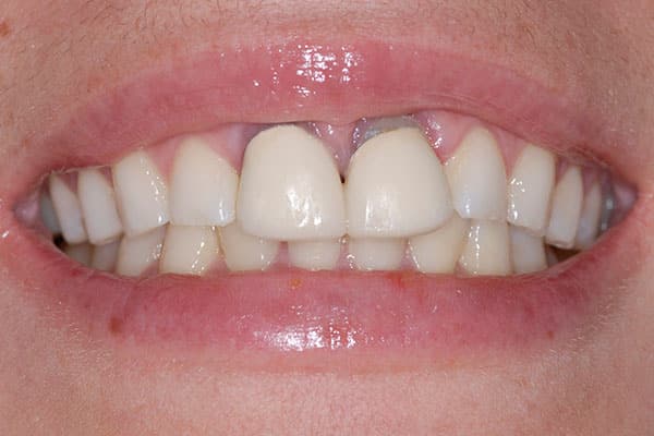 Smile design before and after