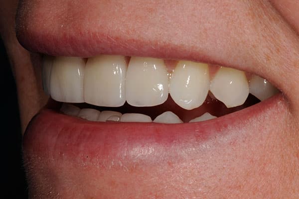 Gorgeous dental transformation with temporary veneers