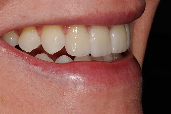 Stunning dental transformation with ceramic veneers