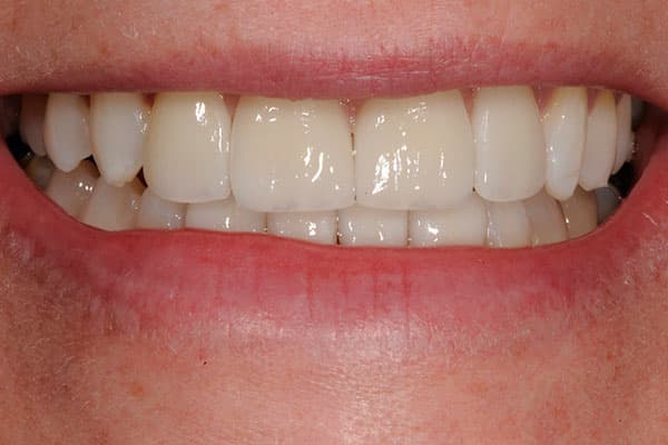 Breathtaking dental transformation with teeth bonding