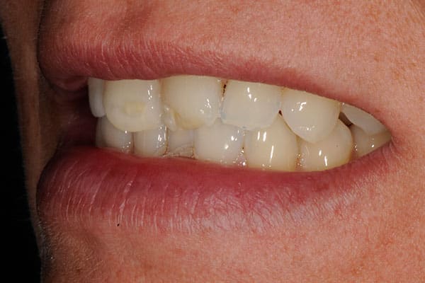 Beautiful smile transformation with permanent veneers