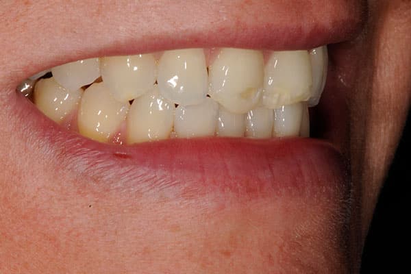 Incredible smile transformation with resin veneers