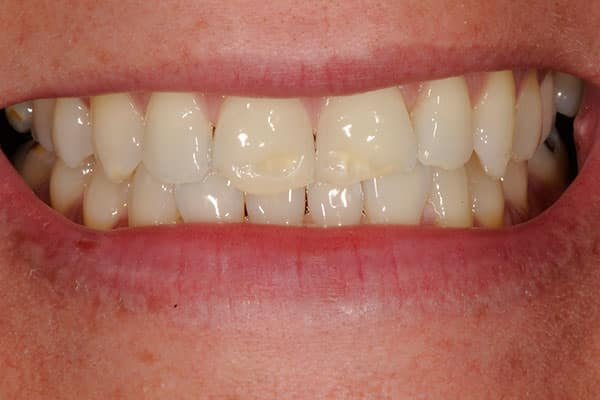 Spectacular smile transformation with tooth reshaping