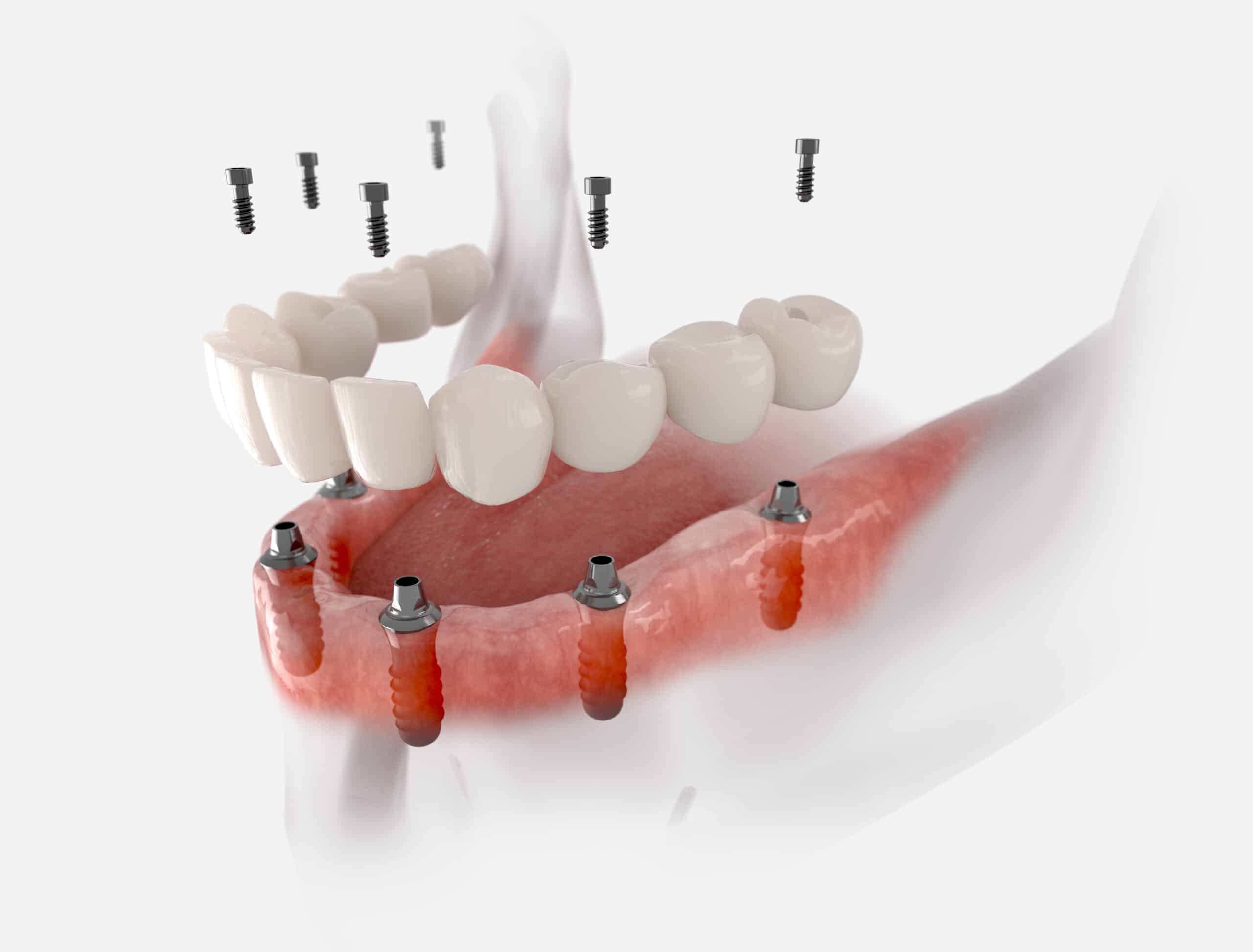 What are the top reasons to choose dental implants