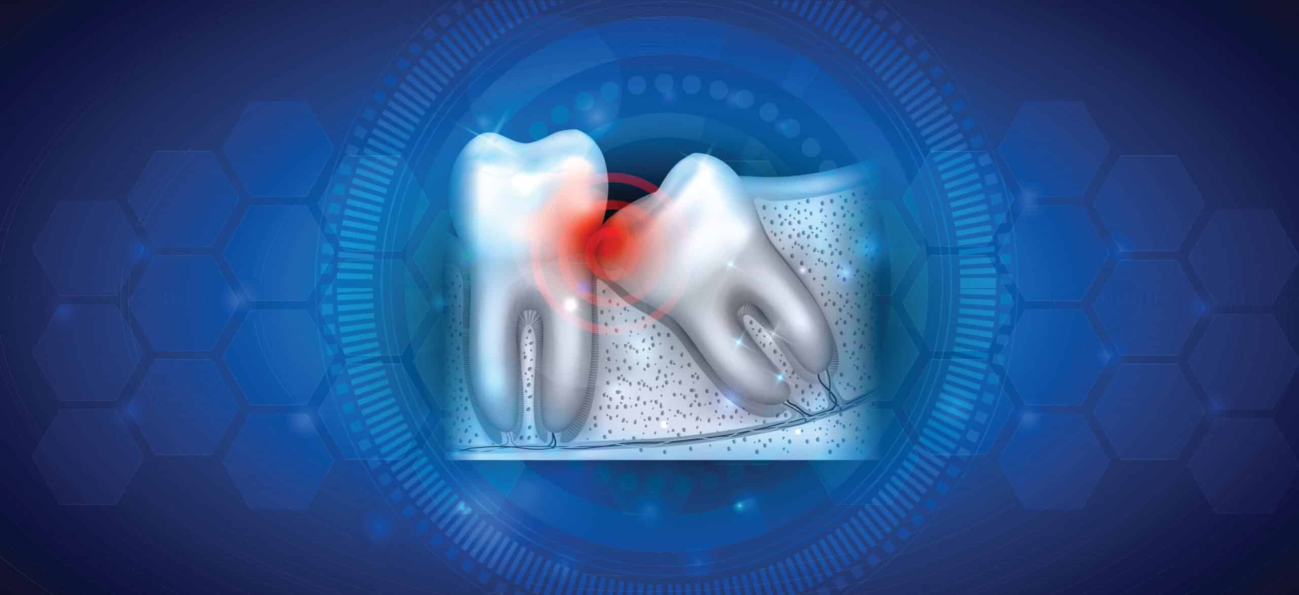 What is An Impacted Wisdom Tooth