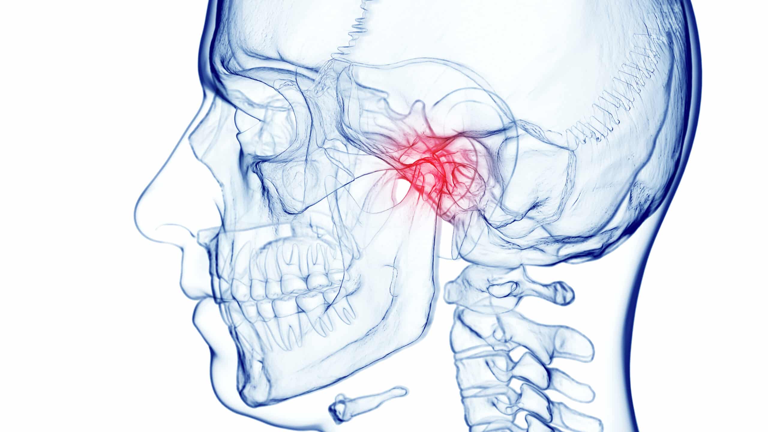 Bruxism and TMJ