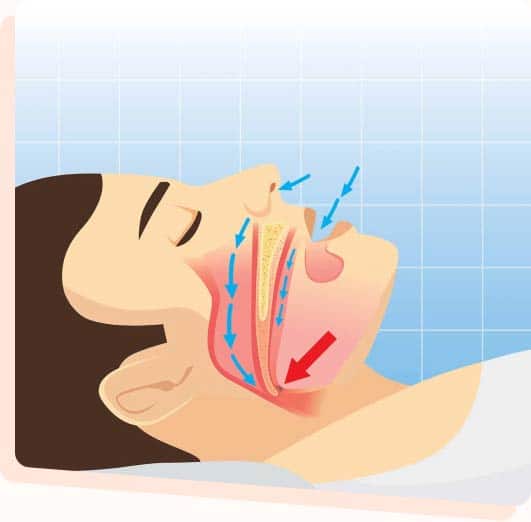 Sleep Apnea Treatment Options