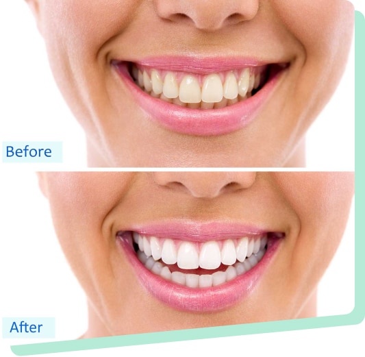 Zoom Tooth Whitening System