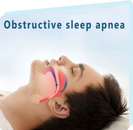 Sleep Apnea Treatment in Mississauga, ON