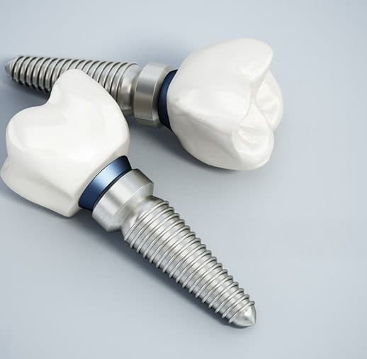 best dental implant clinic Mississauga