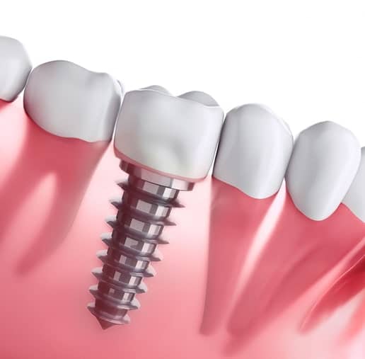 same-day dental implants Mississauga