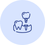 Single Missing Tooth Replacement
